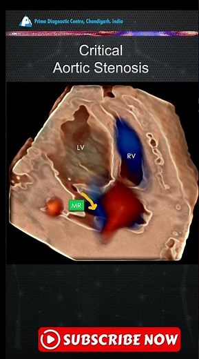🔥 Fetal Critical Aortic Stenosis in 2D, Color & 3D — A Life-Saving Diagnosis Before Birth!