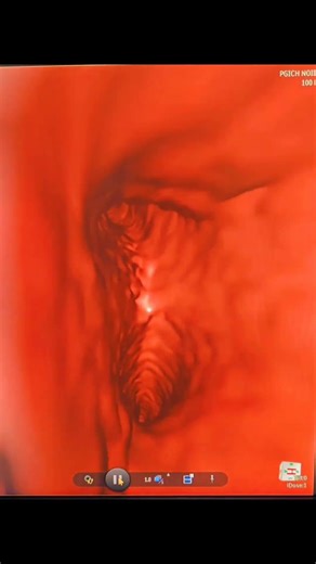 Virtual Bronchoscopy after procedure