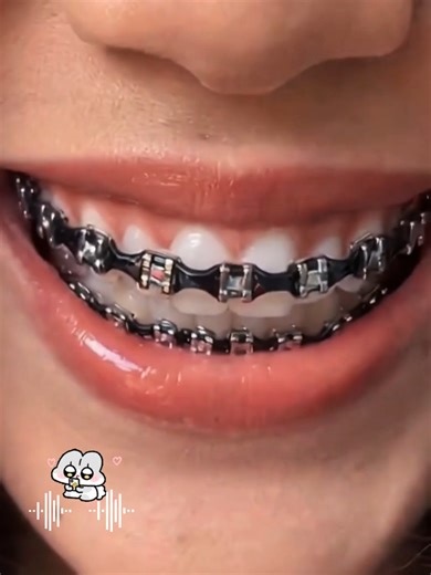 Vibrant brace decors to add fun to your everyday look #jewelry #invisalign #smilemore #braces #TikTokShopJumpstartSale #Fashion #Accessories #ootd #accessorymusthave #HipHop #fyp #TikTokMadeMeBuyIt