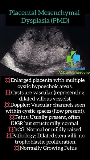 Ultrasound FWB: Placental Mesenchymal Dysplasia #ultrasound #placenta #fwb #shorts