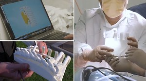 Sydney man undergoes life-changing chest implant