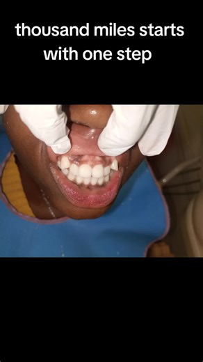 Braces Journey: Amazing Girl's Transformation