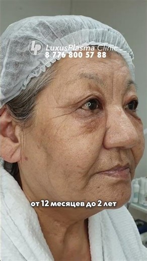 Does warm plasma work and how long do the results last after the rejuvenation procedure?