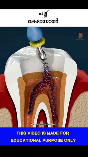 പല്ല് കേടായാൽ #shorts