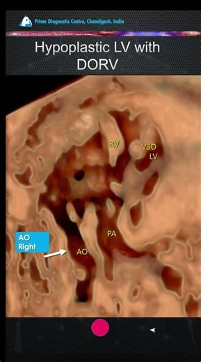 HLHS with VSD & DORV?! 🤯 Rare Fetal Heart Combination Explained in 60 Seconds ❤️🫀
