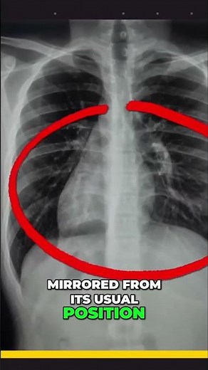 Situs Inversus: Rare Condition Explained in Simple Terms! #shorts