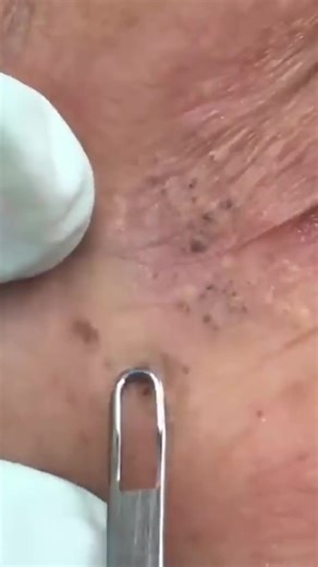 Sandra Lee, MD, FAAD, FAACS on Instagram: "These are good examples of solar comedones - called Favre-Racouchot. They occur when your pores get clogged with oil and debris and turn dark from exposure to the sun. The best way to avoid getting these, particularly if you spend a lot of time outdoors, is to keep your skin clean and exfoliated - use a good cleanser and a retinol, or an exfoliating, salicylic acid cleanser!⁠ ⁠ #drpimplepopper #popaholics #dermatology"