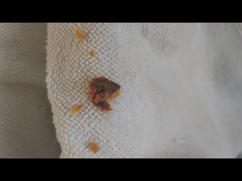 Como desentupir o ouvido em casa retirando cerume interno .