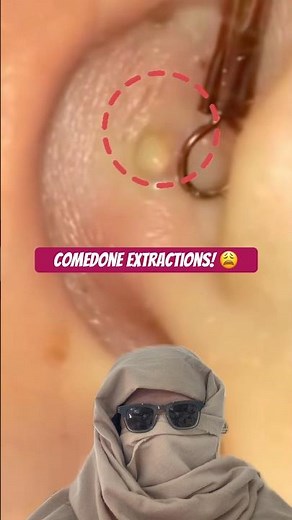 Using a comedone extractor to remove whiteheads 😩 #oddlysatisfying #pimples #youtubeshorts #acne