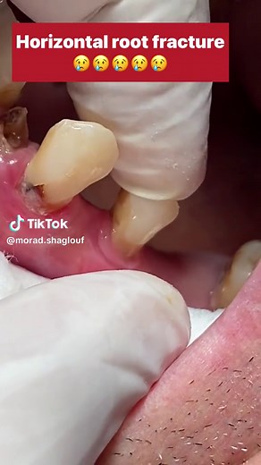 Horizantal root fracture #dentist #dental #dentistry #fyp #viral