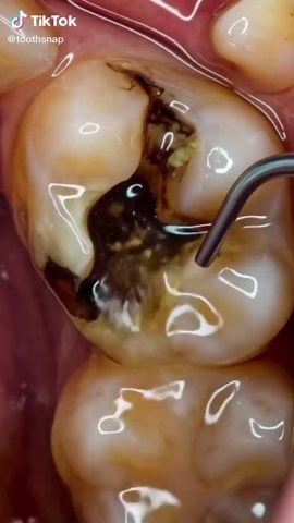 Extremely Rotten Tooth Restored to Perfect Shape #toothcleaning #satisfyingcleaning #asmr