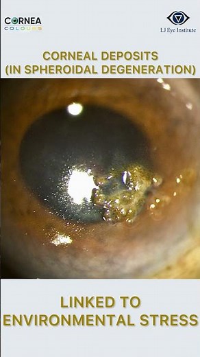 100 Corneal Signs Series | Sign #3: Corneal deposits in Spheroidal degeneration