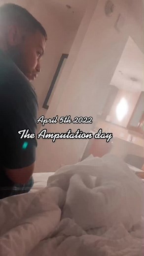April 5th 2022….. amputation day! #amputee #amputeelife #amputation #christiantiktok