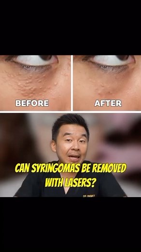 👉🏻 Can Syringomas be removed with lasers? ✨Yes.. But what is Syringomas? 🔘Appearance: Appear as small, firm, flesh-colored or yellowish bumps 🔘Location: Commonly found in clusters around the eyes, although they can occur on other facial areas 🔘Cause: Result from the overgrowth of eccrine sweat gland ducts ✨The only way to remove syringoma is to use heat to shrink up the sweat glands. In Medii Skin, we use Fractional CO2 Laser to remove syringoma. ✨Book your consultation now to discover how 
