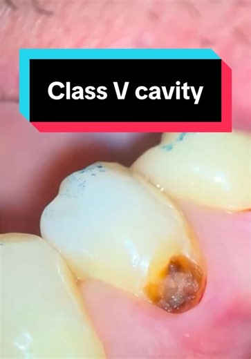 Step-by-Step Class V Restoration Tutorial with Magnification