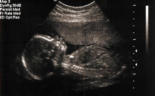 Stillbirths: The psychological and physical toll on expectant mothers