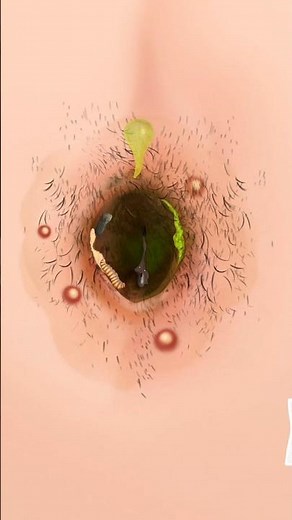 Extreme Belly Button Cleaning ASMR😱 | Navel Dirt & Worm Removal | Oddly Satisfying Animation #shorts