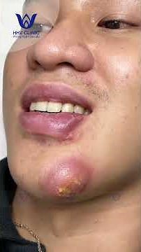 SEVERE CHIN ABSCESS: PATIENT TOO PAINED TO TOUCH IT.