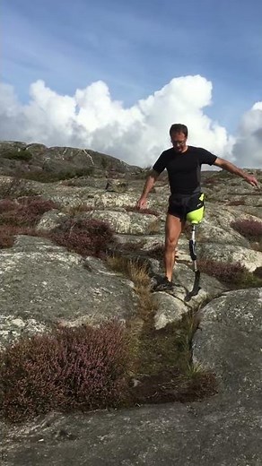 Amputee with short transfemoral stump testing prosthetic leg socket