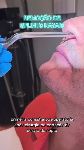 Como funciona o splint nasal na septoplastia