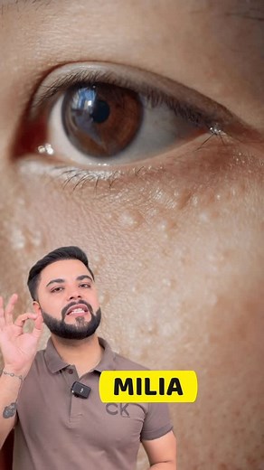 Rohit Sachdeva on Instagram: "Milia, Tiny Bumps & Clogged Pores Permanent Treatment 3 Step Skincare Routine Free Home Delivery all over India 🇮🇳🇮🇳 Whatsapp👇🏻 9953702929 9891002929 9211719431 Store Name: S-Care Cosmetics 710,Dr Mukherjee Nagar (Opposite Batra Cinema) Delhi-110009 Nearest Metro Station: GTB NAGAR (Exit from Gate No. 2) Next to Lenskart Showroom Timings: 11am to 9pm (Monday Closed) Disclaimer • This video is not sponsored by any brand.The information provided on this channel