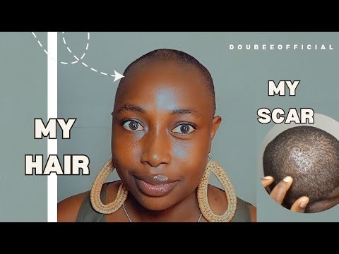 Why I cut my Hair | My Scar story (little) | Healing