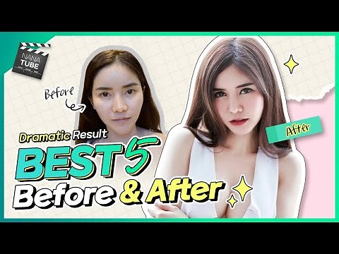 Stunning Before and After Surgery Transformation in Korea Plastic Surgery Hospital! |Dramatic Result