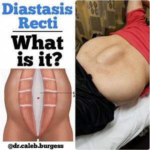💥Diastasis Recti💥 - 📌 Diastasis Recti is a separation of the 2 muscle bellies of the rectus abdominis (6 pack muscle) at the linea alba, which is the connective tissue that usually holds them together. It is commonly seen in pregnant women, premature infants, and in overweight individuals with a large abdomen, as this serves to put more pressure on this region - 📌 A positive diagnosis can be made clinically if you can place 2 or more fingers (~ 2 cm) between the 2 muscle bellies - 📌 Is it c