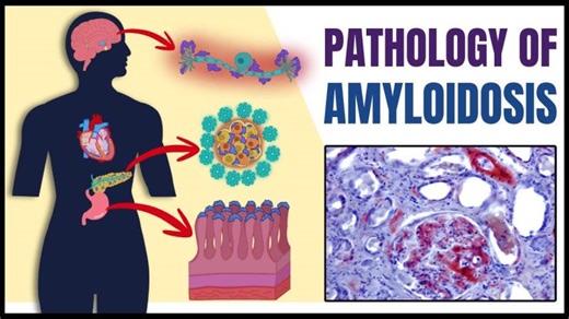 Amyloidosis Explained: AL, AA ATTR Amyloidosis | Pathology, Symptoms, Diagnosis Treatment | Mahrukh Saeed Gillani