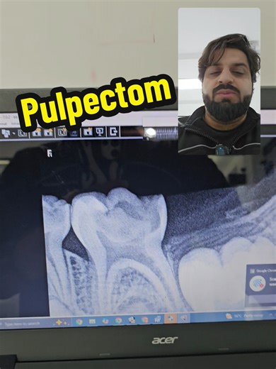 Understanding Pulpectomy Dental Procedure