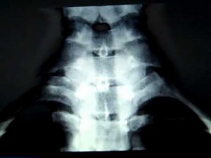 Cervical Rib.mp4