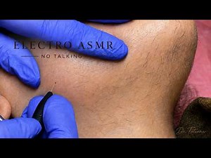Macro Facial Hair Removal | Precision Electrolysis ASMR — Session 02