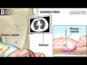 What is guided FNAC? - Dr. Sanjeev Katti