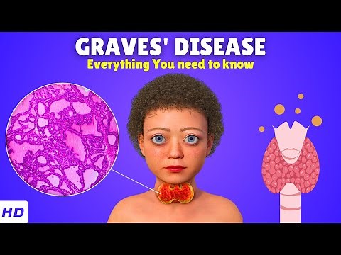 Graves' Disease – Causes, Signs and Symptoms, Diagnosis & Treatment