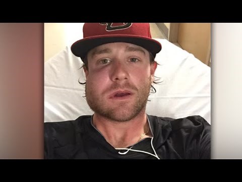 Ball travelling 115 mph strikes pitcher in face