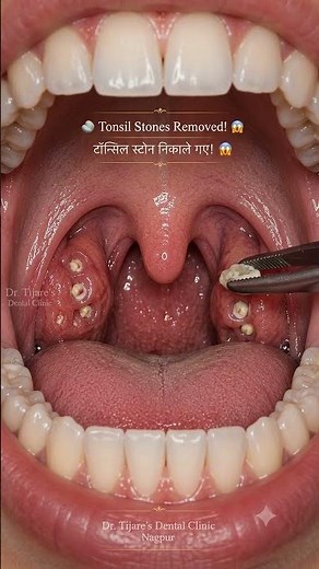 🪨 Tonsil Stone Removal ASMR 😱 | Instant Tonsil Stone Extraction | टॉन्सिल स्टोन निकाले गए!