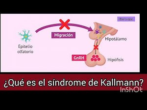 ¿Qué es el síndrome de Kallmann?