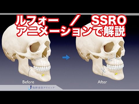 上下顎骨切り術、両顎手術、ルフォー、SSRO（下顎分割矢状骨切り術）についてわかりやすくアニメーションで紹介