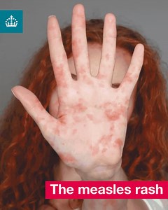 A blotchy, sometimes raised, rash is one of the signs of #Measles. It’s not usually itchy, and it can look different on different skin tones. 🧒🏼🔴🧒🏾 If you think you or your child has measles, contact your GP practice urgently or call NHS 111. 📞 | UK Health Security Agency