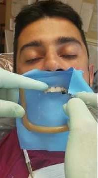 Bioclear Direct Diastema Closure - Evaluating Incisal Length