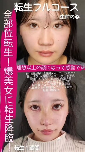 たいせい先生(辻 大成)👾Tokyo Tensei Clinic統括代表👾 on Instagram: "約束された勝利のオペ【転生フルコース】毎日予約が殺到してます✨シュッとしたフェイスラインやあご下のラインは勿論のこと、印象的なお目元、圧倒的鼻の曲線美を爆誕✨ 看板メニューの転生脂肪吸引、転生リフトに加えて目元やお鼻もセットのフルコースの場合、僕達も限界を超えてお値引き頑張っちゃいます🙄✨なんと約100万近くお値引きが可能です✨ トータルバランスを整えて周囲が震え上がる驚愕の爆美女へ！超越者に転生できます！ 輪郭 ・転生脂肪吸引 全箇所 ・メーラーファット除去 ・転生リフト ・貴族フィラーあごヒアル 目元 ・転生目頭切開 ・転生目尻切開 ・🆕転生白目拡大術 ・🆕転生目上切開 鼻 ・転生プロテーゼ挿入術 ・🆕転生小鼻縮小術 内外側切開 ・耳甲介軟骨移植 ・転生鼻尖形成 ・鼻中隔延長術 ・🆕転生セファリックトリム ご相談はお気軽にInstagramトップの公式ラインからご相談ください✨ #小顔整形 #脂肪吸引 #糸リフト #美容整形 #整形"