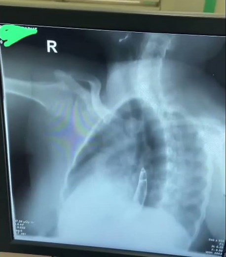 Barium Swallowing