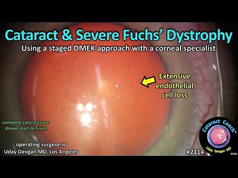 CataractCoach™ 2114: cataract and severe Fuchs; corneal endothelial dystrophy