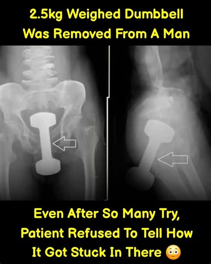 Loyal Insights | Doctors were left shocked after successfully removing a 2.5 kg dumbbell from a man, a case that required careful medical intervention.... | Instagram