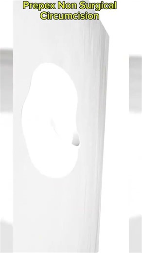 Prepex Non Surgical Circumcision Procedure: Disclaimer: This video #PrePexcircumcision #NonSurgic...
