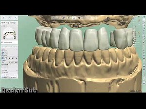 3shape design full arch case (implant case, osstem)