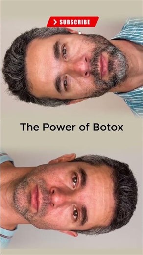 Botox for Men 💉 | Natural, Strong & Confident Look