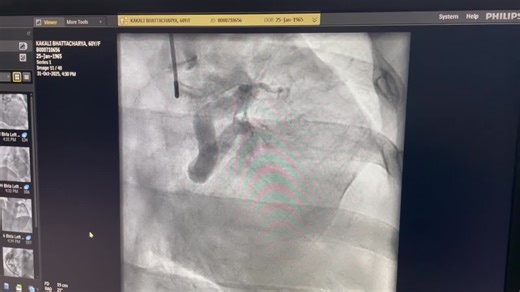 ALCAPA Heart 🫀 | Debsattam Karan