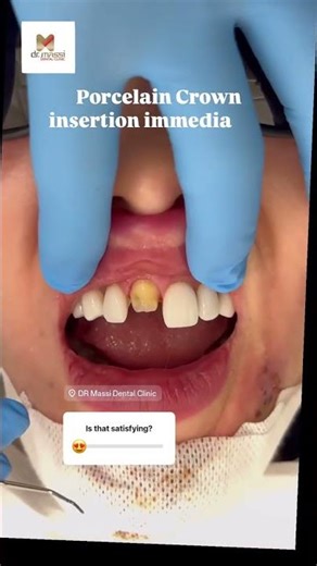 BROKEN FRONT TOOTH 🦷😬