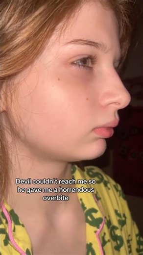 Overjet Explained and How We Fix It!